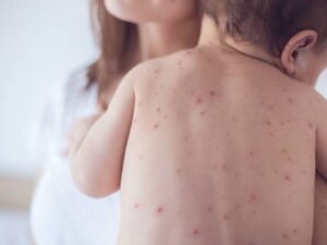 Yumurta Alerjisi Belirtileri Nedir?