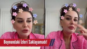 Fenomen Dilan Polat’ın Boynundaki İzler, Takipçilerini Meraklandırdı!